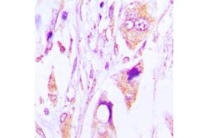 Immunohistochemical analysis of IgG1 staining in human lung cancer formalin fixed paraffin embedded tissue section. (Lapin anti-Humain IgG1 (Center) Anticorps)