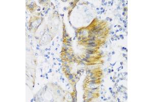 Immunohistochemistry of paraffin-embedded human colon carcinoma using CLDN4 antibody (ABIN6133648, ABIN6138690, ABIN6138691 and ABIN6216719) at dilution of 1:150 (40x lens). (Claudin 4 anticorps  (C-Term))