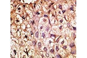 IHC analysis of FFPE human hepatocarcinoma tissue stained with the ACE2 antibody