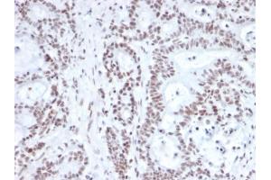 Formalin-fixed, paraffin-embedded human prostate carcinoma stained with NRF1 Mouse Monoclonal Antibody (NRF1/2609). (NFE2L1 anticorps)