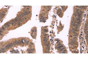 Immunohistochemistry of paraffin-embedded Human colon cancer tissue using FBXO31 Polyclonal Antibody at dilution 1:40 (FBXO31 anticorps)