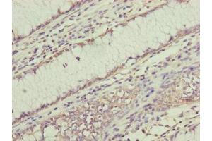 Immunohistochemistry of paraffin-embedded human colon cancer using ABIN7168238 at dilution of 1:100 (RNF11 anticorps  (AA 1-154))