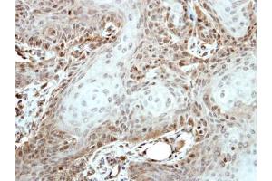 IHC-P Image Immunohistochemical analysis of paraffin-embedded Cal27 xenograft, using OCT3/4, antibody at 1:500 dilution. (OCT4 anticorps)