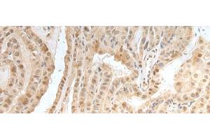 Immunohistochemistry of paraffin-embedded Human thyroid cancer tissue using ZNF24 Polyclonal Antibody at dilution of 1:35(x200) (ZNF24 anticorps)