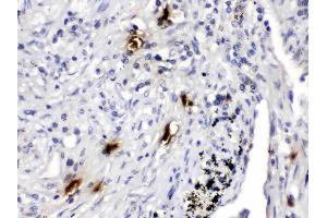 Mast Cell Tryptase was detected in paraffin-embedded sections of human lung cancer tissues using rabbit anti- Mast Cell Tryptase Antigen Affinity purified polyclonal antibody (Catalog # ) at 1 µg/mL. (TPSAB1 anticorps  (AA 65-275))
