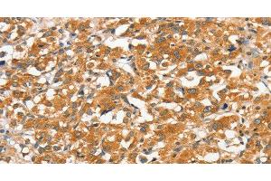 Immunohistochemistry of paraffin-embedded Human thyroid cancer tissue using ANKMY2 Polyclonal Antibody at dilution 1:30 (ANKMY2 anticorps)