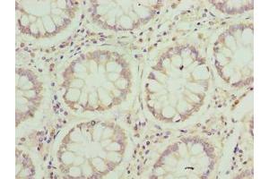 Immunohistochemistry of paraffin-embedded human colon cancer using ABIN7165668 at dilution of 1:100 (JAGN1 anticorps  (AA 1-39))