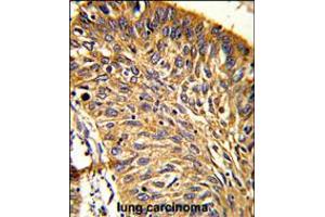Formalin-fixed and paraffin-embedded human lung carcinoma reacted with PRDX3 Antibody (N-term), which was peroxidase-conjugated to the secondary antibody, followed by DAB staining. (Peroxiredoxin 3 anticorps  (N-Term))