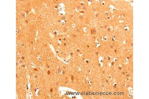Immunohistochemistry of Human liver cancer using GRM3 Polyclonal Antibody at dilution of 1:50 (Metabotropic Glutamate Receptor 3 anticorps)