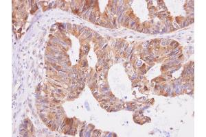 IHC-P Image Aspartyl aminopeptidase antibody [N1N3] detects Aspartyl aminopeptidase protein at cytoplasm on human colon carcinoma by immunohistochemical analysis.