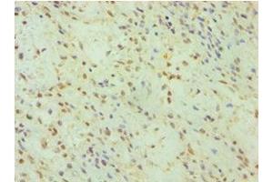 Immunohistochemistry of paraffin-embedded human breast cancer using ABIN7153663 at dilution of 1:100 (Non-Syndromic Hearing Impairment Protein 5 (GSDME) (AA 1-260) anticorps)