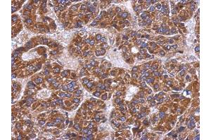 IHC-P Image Immunohistochemical analysis of paraffin-embedded human hepatoma, using C4 binding protein B, antibody at 1:500 dilution.