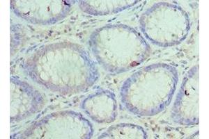 Immunohistochemistry of paraffin-embedded human colon cancer using ABIN7156024 at dilution of 1:100