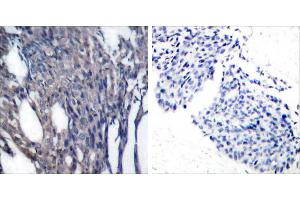 P-Peptide - +Immunohistochemical analysis of paraffin-embedded human breast carcinoma tissue using IκB-α (phospho-Tyr42) antibody. (NFKBIA anticorps  (pTyr42))