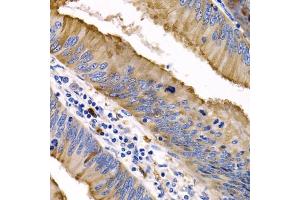 Immunohistochemistry of paraffin-embedded human colon cancer using IL9 antibody (ABIN3015677, ABIN3015678, ABIN1680463 and ABIN6219030) at dilution of 1:200 (40x lens). (IL-9 anticorps  (AA 19-144))