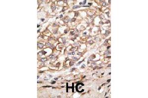 Formalin-fixed and paraffin-embedded human hepatocellular carcinoma tissue reacted with SIGLEC11 polyclonal antibody  , which was peroxidase-conjugated to the secondary antibody, followed by AEC staining. (SIGLEC11 anticorps  (C-Term))