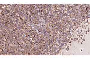 ABIN6273181 at 1/100 staining Human lymph cancer tissue by IHC-P. (TRIM9 anticorps  (N-Term))