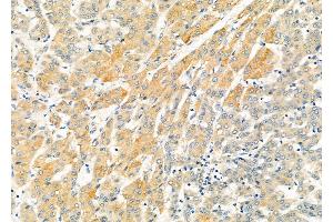 ABIN6265622 and ABIN6273178 at 1/100 staining Human liver cancer by IHC-P. (TMSB4X anticorps  (N-Term))