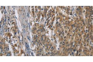 Immunohistochemistry of paraffin-embedded Human gastic cancer using SIGMAR1 Polyclonal Antibody at dilution of 1:50 (SIGMAR1 anticorps)