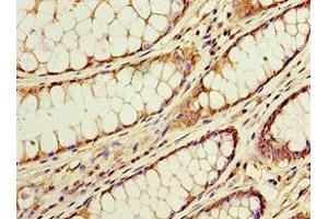 Immunohistochemistry of paraffin-embedded human colon cancer using ABIN7143228 at dilution of 1:100 (ACSM3 anticorps  (AA 387-586))
