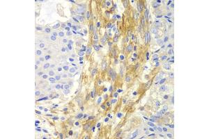 Immunohistochemistry of paraffin-embedded human oophoroma using FLNA antibody (ABIN5975863) at dilution of 1/100 (40x lens). (Filamin A anticorps)