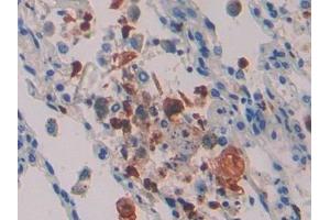 Detection of IL16 in Human Lung cancer Tissue using Polyclonal Antibody to Interleukin 16 (IL16)