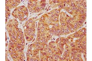 IHC image of ABIN7163307 diluted at 1:200 and staining in paraffin-embedded human liver cancer performed on a Leica BondTM system.