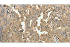 Immunohistochemistry of paraffin-embedded Human ovarian cancer using PSMD9 Polyclonal Antibody at dilution of 1:50