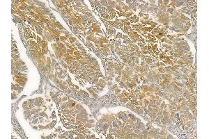 ABIN6257069 and ABIN6274978 at 1/100 staining human lung squamous cell carcinoma by IHC-P.