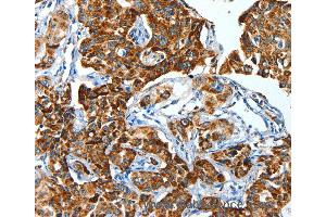 Immunohistochemistry of Human lung cancer using ALDH6A1 Polyclonal Antibody at dilution of 1:45 (ALDH6A1 anticorps)