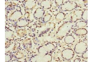 Immunohistochemistry of paraffin-embedded human gastric cancer using ABIN7154322 at dilution of 1:100 (GBF1 anticorps  (AA 1-85))