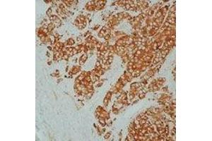 Formalin-fixed, paraffin-embedded  human breast carcinoma stained with Heat Shock Protein 27  using peroxidase-  conjugate and DAB chromogen. (HSP27 anticorps)