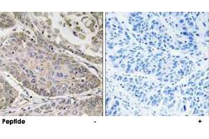 Immunohistochemistry analysis of paraffin-embedded human lung carcinoma tissue using PLA2G4E polyclonal antibody .