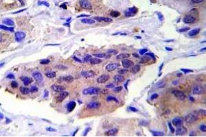 Immunohistochemistry (IHC) analyzes of GSK3alpha pAb in paraffin-embedded human breast carcinoma tissue. (GSK3 alpha anticorps)