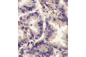 Immunohistochemistry (IHC) image for anti-Vascular Endothelial Growth Factor C (VEGFC) antibody (ABIN3001426) (VEGFC anticorps)