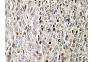 Immunohistochemistry analyses of FOXE3 in human prostate carcinoma tissue (Formalin-fixed, Paraffin-embedded) using FOXE3 / FKHL12 antibody .
