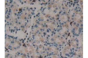 IHC-P analysis of Human Stomach cancer Tissue, with DAB staining. (Midkine anticorps  (AA 22-143))