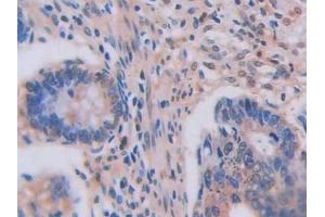 Detection of LOXL2 in Human Colorectal cancer Tissue using Polyclonal Antibody to Lysyl Oxidase Like Protein 2 (LOXL2)