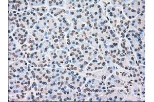 Immunohistochemical staining of paraffin-embedded Adenocarcinoma of ovary tissue using anti-CHEK2mouse monoclonal antibody. (CHEK2 anticorps)