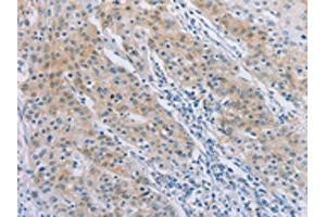 The image on the left is immunohistochemistry of paraffin-embedded Human gastric cancer tissue using ABIN7189712(AGAP2 Antibody) at dilution 1/30, on the right is treated with synthetic peptide. (AGAP2 anticorps)