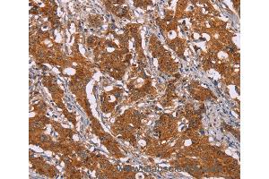 Immunohistochemistry of Human breast cancer using DCTN6 Polyclonal Antibody at dilution of 1:40