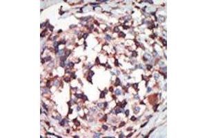 Formalin-fixed and paraffin-embedded human cancer tissue reacted with the primary antibody, which was peroxidase-conjugated to the secondary antibody, followed by AEC staining.