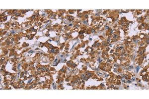 Immunohistochemistry of paraffin-embedded Human thyroid cancer using Cyclophilin F Polyclonal Antibody at dilution of 1:45