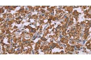 Immunohistochemistry of paraffin-embedded Human thyroid cancer using Cyclophilin F Polyclonal Antibody at dilution of 1:45 (PPIF anticorps)
