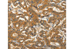 Immunohistochemistry of Human thyroid cancer using ADCY3 Polyclonal Antibody at dilution of 1:50 (ADCY3 anticorps)