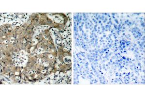 Peptide - +Immunohistochemical analysis of paraffin-embedded human breast carcinoma tissue using FKHR (Ab-319) antibody (#B7086). (FOXO1 anticorps  (Ser319))