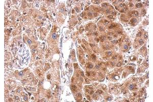 IHC-P Image StAR antibody detects StAR protein at cytosol on human hepatoma by immunohistochemical analysis. (STAR anticorps)