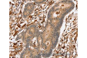 Immunohistochemistry of Human colon cancer using SSX2IP Polyclonal Antibody at dilution of 1:45 (SSX2IP anticorps)