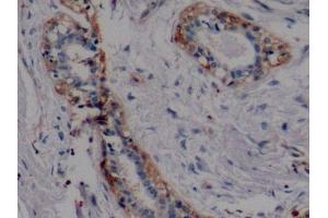 Detection of MUC1 in Human Breast cancer Tissue using Polyclonal Antibody to Mucin 1 (MUC1)