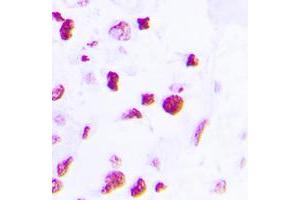 Immunohistochemical analysis of C/EBP beta staining in human lung cancer formalin fixed paraffin embedded tissue section.